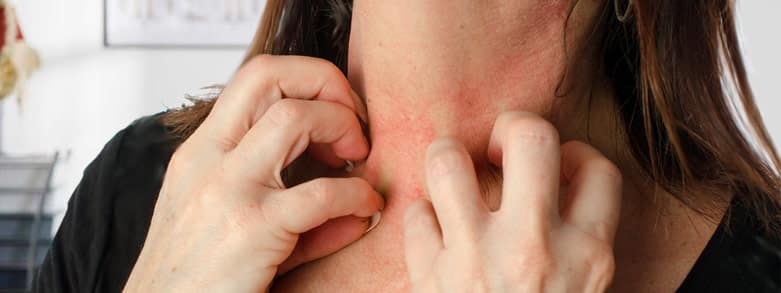 Nässelutslag (Urtikaria)